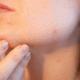 Kulit Bruntusan ingin Glowing? Terapkan Tips Kecantikan Ini!